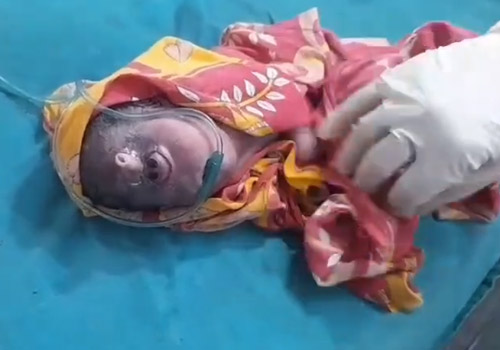 बक्सर में बेहद रेयर कंडीशन का मामला, बच्चे को बड़े सेंटर रेफर किया गया